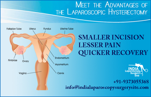 Most Efficient and Low cost Laparoscopic Hysterectomy Surgery